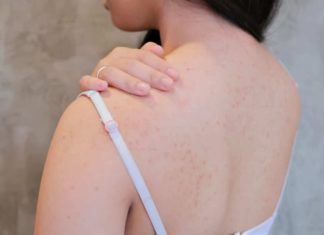 6 Simple Solutions to Get Rid of Back and Body Acne