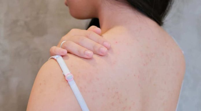 6 Simple Solutions to Get Rid of Back and Body Acne