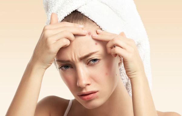 How to Take Care of Your Skin After Popping a Pimple to Prevent Long-lasting Scars