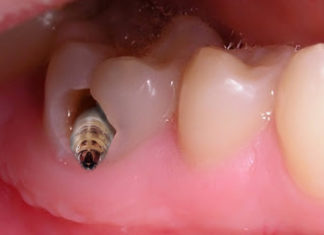 Addicted to a popular drink, 14-year-old boy almost loses his entire set of teeth