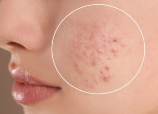 Do Pregnant Women Get Acne? Is It Accurate to Determine the Gender of the Baby Based on That?