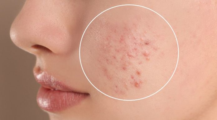 Do Pregnant Women Get Acne? Is It Accurate to Determine the Gender of the Baby Based on That?