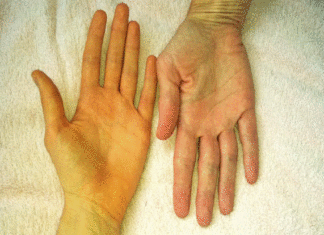 7 Signs of Toxicity in the Liver, Urgently in Need of Detoxification