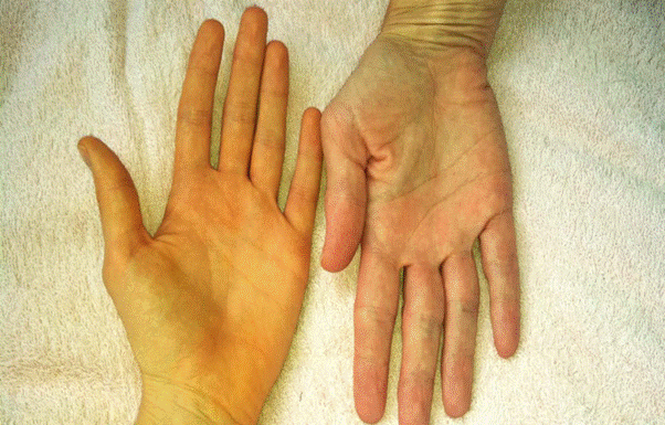 7 Signs of Toxicity in the Liver, Urgently in Need of Detoxification