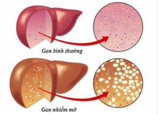 6 Simple Ways to Detoxify Your Liver for a Healthy and Strong Liver