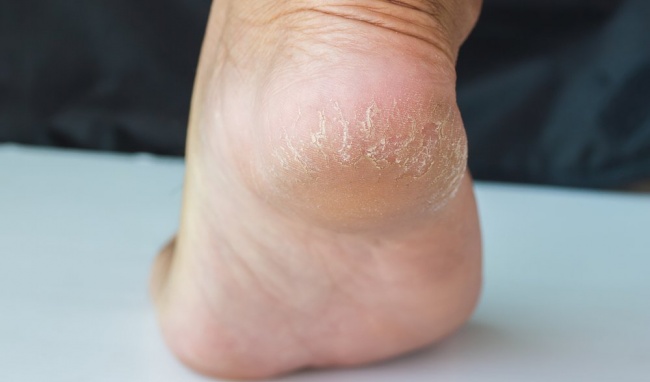 4 Natural Remedies to Repair Cracked Heels