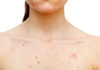 Simple Tips to Combat Chest Acne for Women