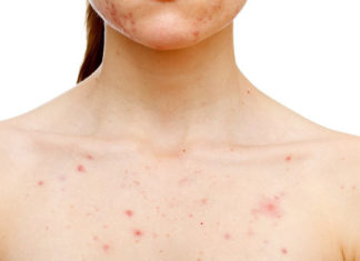 Simple Tips to Combat Chest Acne for Women