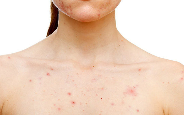 Simple Tips to Combat Chest Acne for Women