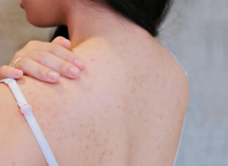6 Simple Habits to Get Rid of Back Acne