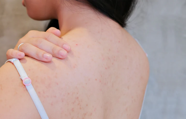 6 Simple Habits to Get Rid of Back Acne
