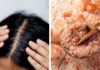 Use Common Spice to Clean Your Scalp and Reduce Dandruff and Hair Loss