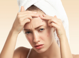 The Complete Guide to Safe Acne Extraction without Scarring or Hyperpigmentation