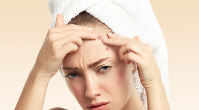 The Complete Guide to Safe Acne Extraction without Scarring or Hyperpigmentation