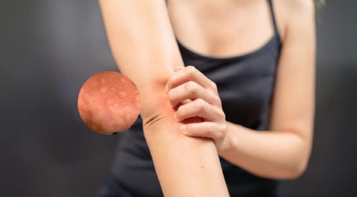 Check for Kidney Disease if You Experience Itching or Muscle Cramps Today