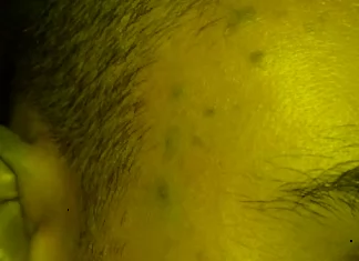 What Does Acne on the Face Indicate About Your Body’s Problems?