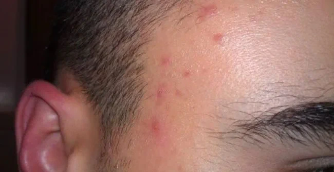 What Does Acne on the Face Indicate About Your Body’s Problems?