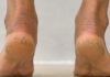 “Try These 3 Easy Home Remedies with Vaseline to Heal Cracked Heels”