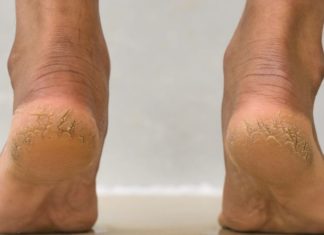 “Try These 3 Easy Home Remedies with Vaseline to Heal Cracked Heels”