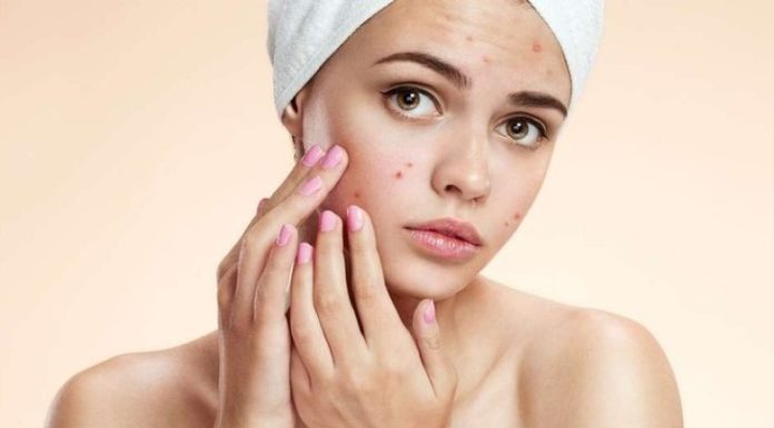“Try These 5 Easy Natural Remedies to Help Fight Acne”
