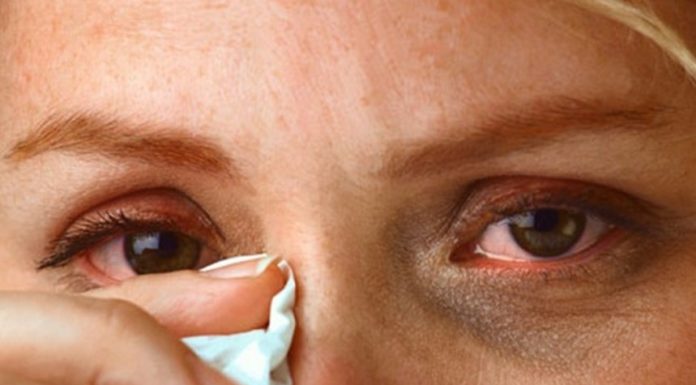 Coping with Conjunctivitis During Floods: Causes, Symptoms, and Prevention Strategies