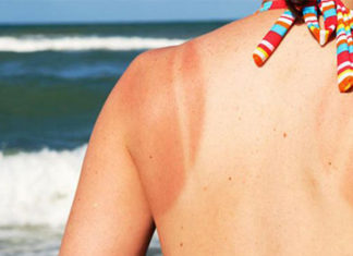 How to Treat 5 Common Skin Issues During Hot Weather