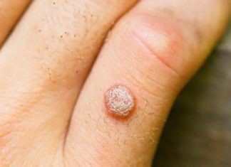 Revealing the Surprising Ability of Fresh Betel Leaf to Combat Acne