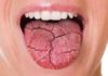 Say Goodbye to Dry Mouth with Simple Tricks