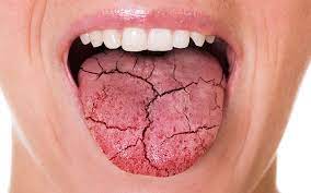 Say Goodbye to Dry Mouth with Simple Tricks