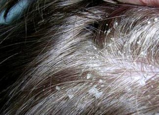 Vinegar Solutions to Combat Stubborn Dandruff and Scalp Fungal Infections