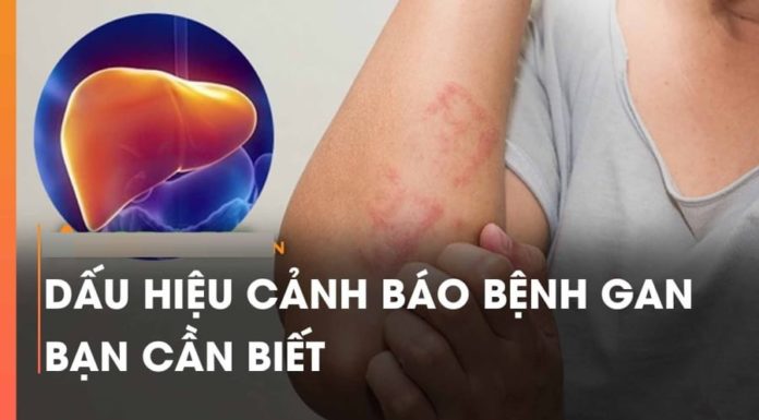 1 “Symptom” your body makes, beware of severe liver disease, treating it is difficult