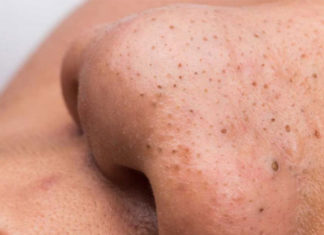 Understanding Obagi Trio for Blackhead Treatment Benefits