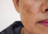 A Comprehensive Guide to Treating Melasma