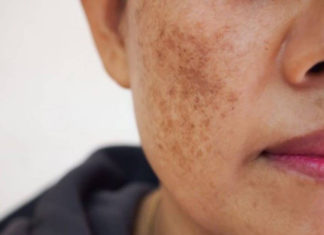 A Comprehensive Guide to Treating Melasma