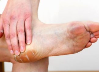 Treating Cracked Heels with Snake Oil Proven Effective