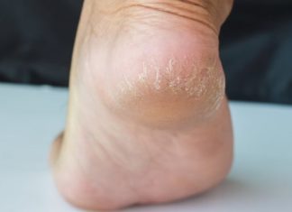 3 Effective Ways to Heal Dry and Cracked Heels in the Cold Weather