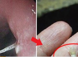 Tips for curing fishbone stuck in your throat without seeing a doctor in no time