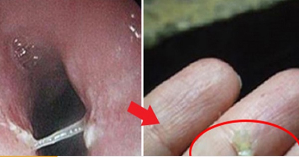 Tips for curing fishbone stuck in your throat without seeing a doctor in no time