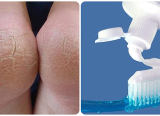 Using Toothpaste: A Guide to Effectively Treat Cracked Heels