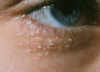 5 Effective Ways to Remove Skin Tags