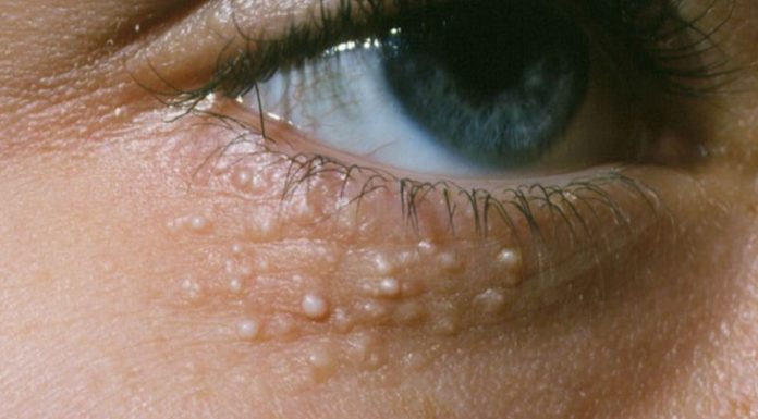 5 Effective Ways to Remove Skin Tags