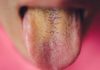 If Your Tongue is Yellow, Beware of These 5 Diseases