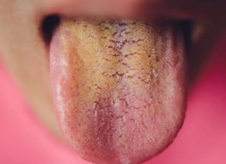 If Your Tongue is Yellow, Beware of These 5 Diseases