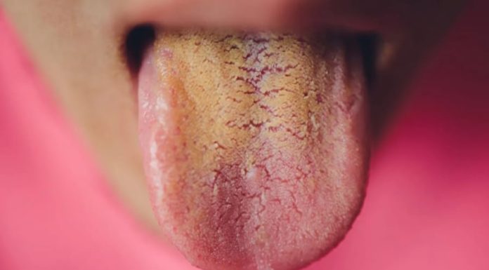 If Your Tongue is Yellow, Beware of These 5 Diseases