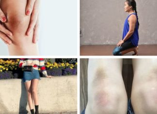 Treating Dark Knees with Easy-to-Find Ingredients