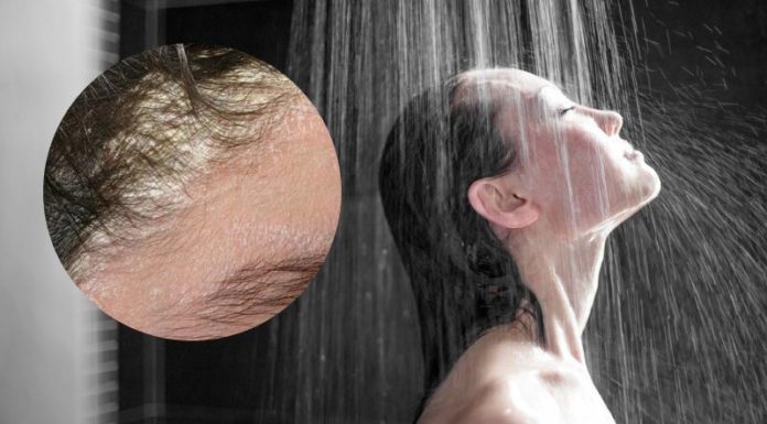 Investigating the Relationship Between Bedtime Showers and Dandruff Occurrence