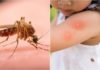 Tips to Reduce Itching from Mosquito Bites