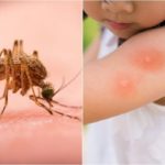 Tips to Reduce Itching from Mosquito Bites