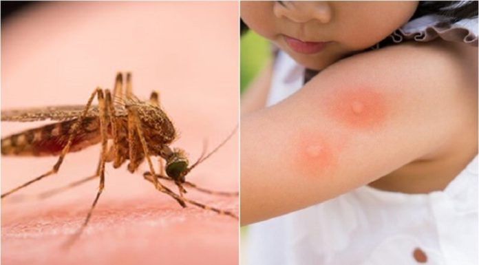 Tips to Reduce Itching from Mosquito Bites