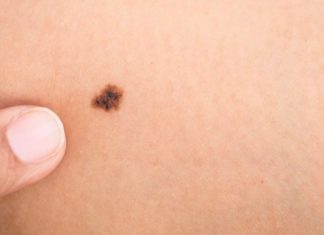 Effects of Not Wearing Sunscreen